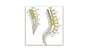 Anestesia Neuroaxial En Pediatria Ppt