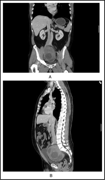 Management Of Benign Retroperitoneal Schwannomas A Single Center