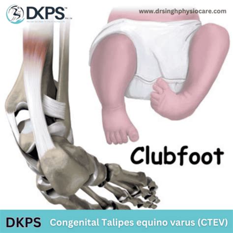 What Is Congenital Talipes Equino Varus Drsinghphysiocare