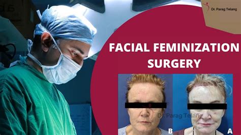 Facial Feminization Surgery Ffs Surgery At Designer Bodyz Facial