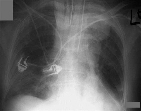 Tension Hydrothorax A Near Fatal Complication Of Central Venous