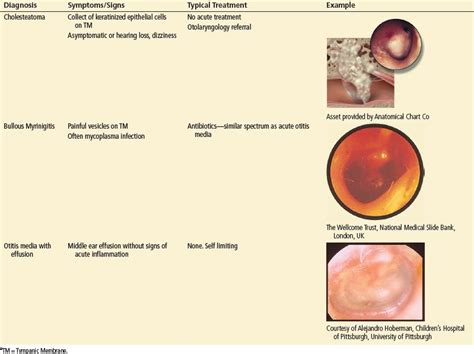 Ear Infection Acute Pictures