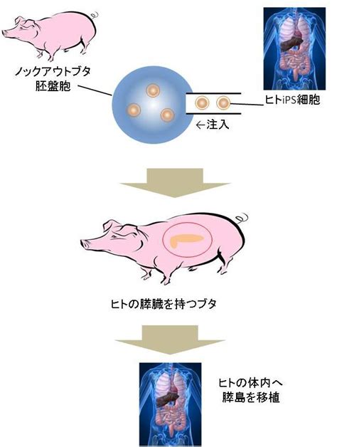 糖尿病の情報 再生医療とips細胞の医療情報／ニュースサイト「エヌオピ」