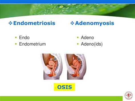 Ppt Endometriosis And Adenomyosis Powerpoint Presentation Free