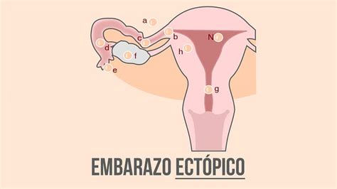 Embarazo Ectópico Qué Es Causas Síntomas Y Tratamiento