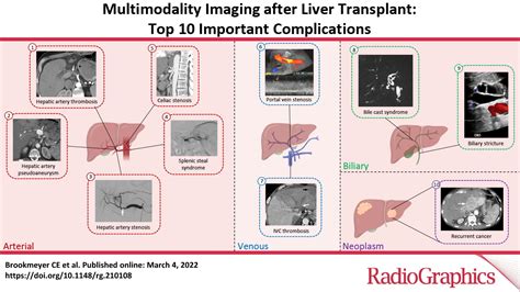 Multimodality Imaging After Liver Transplant Top 10 Important Complications Radiographics