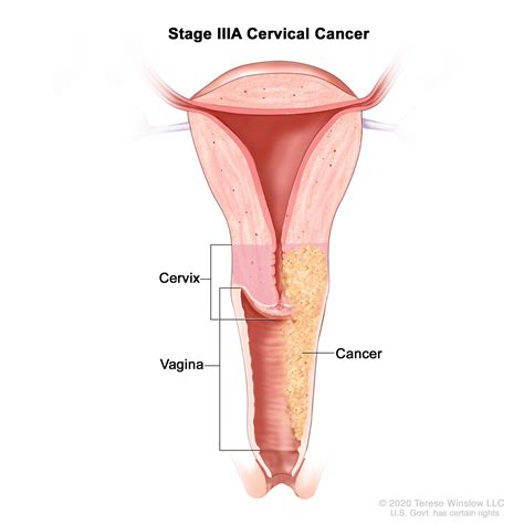 Cervical Cancer Stages