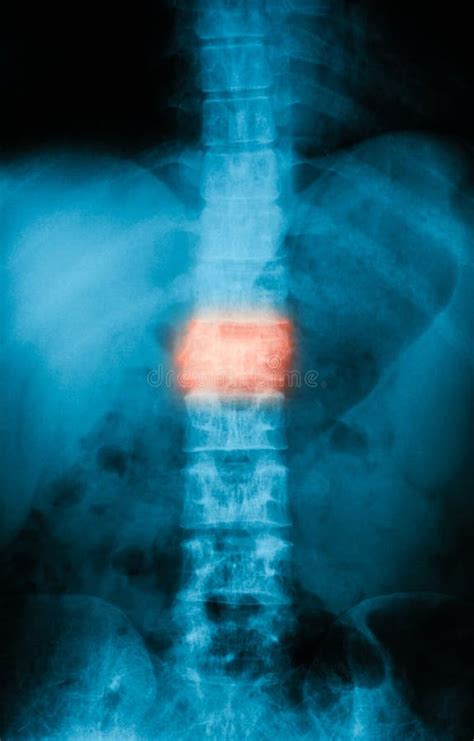 X-ray Image of Lumbar Spine, AP View. Stock Image - Image of diagnosis ...