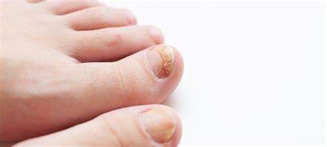 How To Treat Nail Fungus Effectively Nail Fungus Treatment