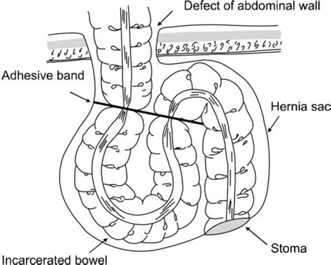 An Adhesive Band Extending From The Parastomal Hernia S Open I