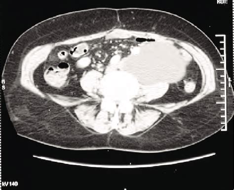 Tdm Abdominale Montrant Un Kyste Hydatique Du Muscle Psoas Gauche