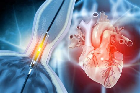 Cryoballoon Vs Radiofrequency Ablation For Persistent Af Safety And Efficacy The Cardiology