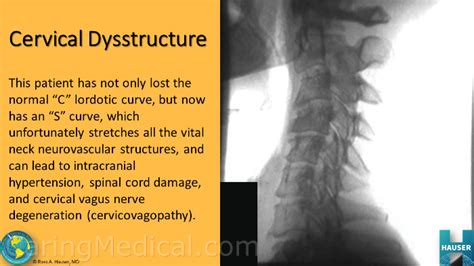 Chronic Neck Related Symptoms Without Neck Pain Part 2 Vagus Nerve