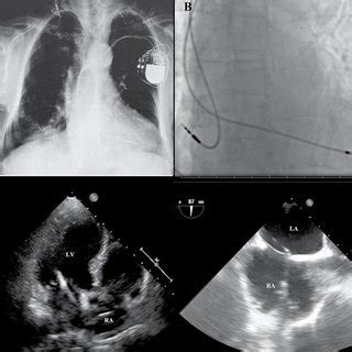 A Chest Radiography B Fluoroscopic Image C Transthoracic