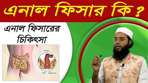 এনল ফসরর হমও চকৎস এনল ফশর পযখনর রসতয জবলপড Anal Fissure