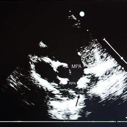 Transthoracic Echocardiogram Showing Main Pulmonary Artery MPA Giving