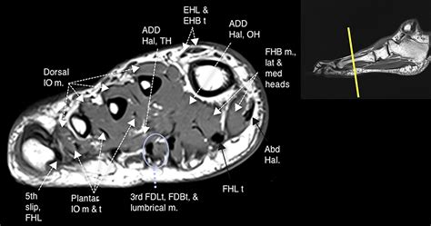 Plantar Foot Muscles Mri - MRI IN FOOT PAIN - 31 the plantar intrinsic foot muscles consist of ...