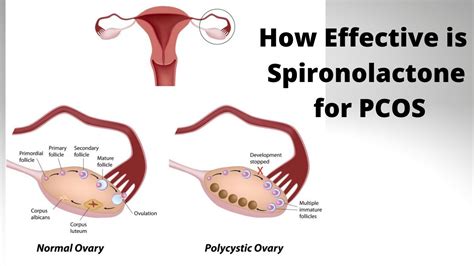 How Effective is Spironolactone for PCOS - YouTube