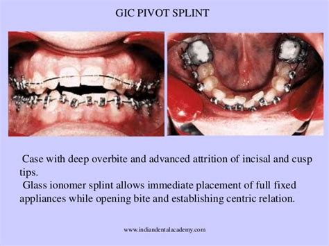 Orthodontic Splints Certified Fixed Orthodontic Courses By Indian De