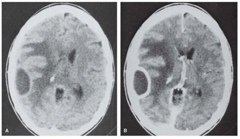 Acute Bacterial Meningitis And Infective Endocarditis Neupsy Key