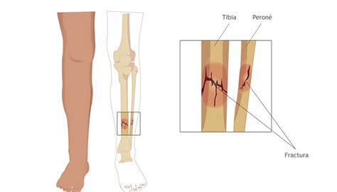 Tratamiento Y Rehabilitación De Fractura O Rotura De Tibia Y Peroné Salud