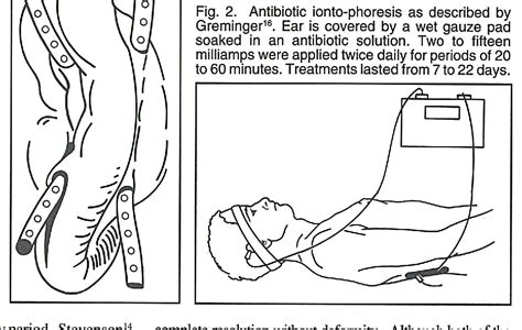 Chondritis of the Burned Ear: A Review | Semantic Scholar