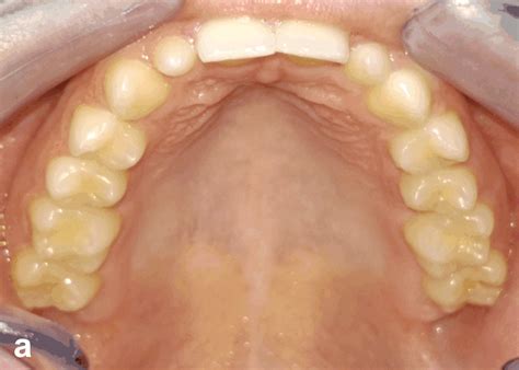 A C Conical Shape Of The Maxillary Permanent Lateral Incisors The