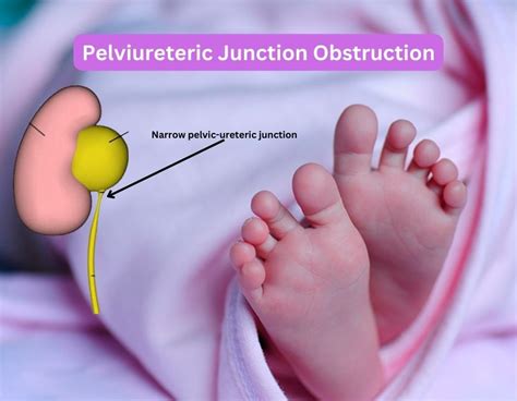 Pelviureteric Junction Obstruction Causes Symptoms Dr Geeta Kekre