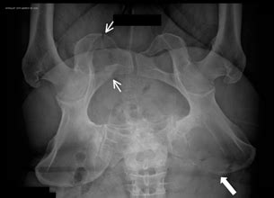 Radiography: small arrows showing fracture of the right ischiopubic and ...