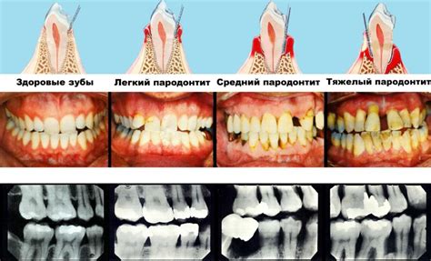 Пародонтит: симптомы, причины, диагностика, профилактика и лечение ...