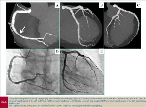 Figure 1 from Spontaneous coronary artery spasm detected by computed ...