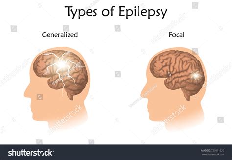 Types Epilepsy Vector Medical Illustration Generalized Stock Vector ...