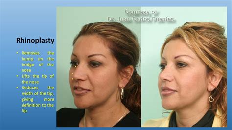 Good Plastic Surgeons In Tijuana Mexico Josie Turpin