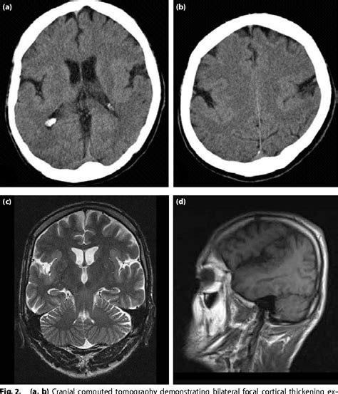 Figure 2 From Congenital Bilateral Perisylvian Syndrome A Case Report