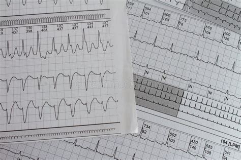 Elettrocardiogramma Con Aritmia Cardiaca Paziente Con Fibrillazione