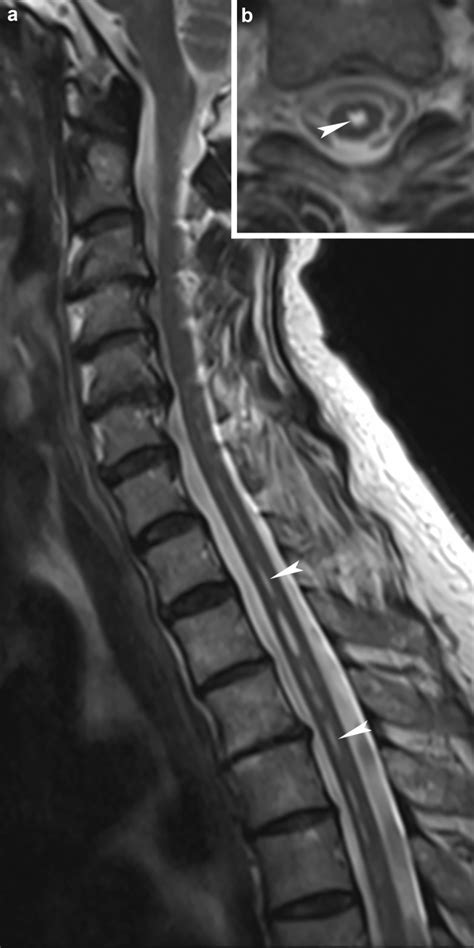 Idiopathic Syrinx Sagittal A And Axial B T Weighted Images Show