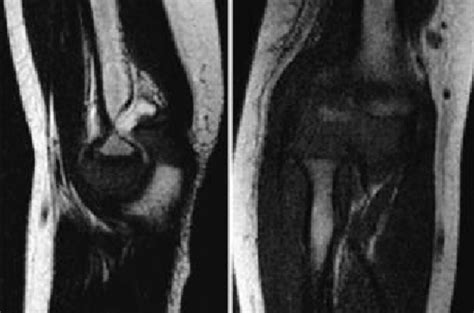 Case one. MRI confirms the diagnosis of humeral lateral condyle ...