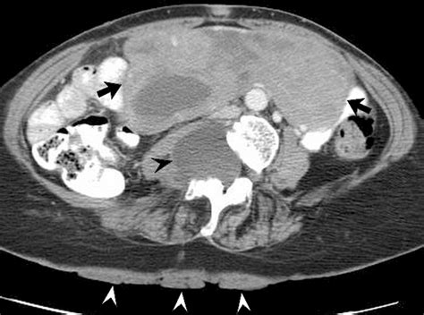 Primary Neoplasms Of Peritoneal And Sub Peritoneal Origin Ct Findings