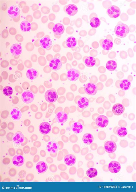 Variation of Normal Neutrophil Cells or PMN Cells in Blood Smear Stock Image - Image of care ...