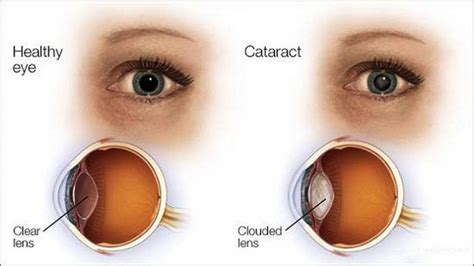 Cataract Surgery Risks Recovery Costs Entirely Health