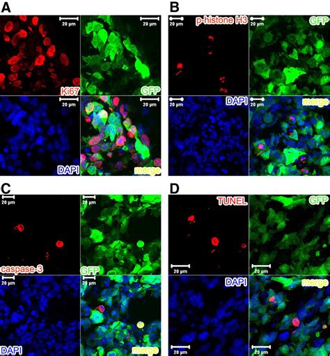 Annexin A2 Promotes Glioma Cell Invasion And Tumor Progression