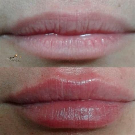 Antes E Depois Do Preenchimento Labial Avaliando Os Resultados