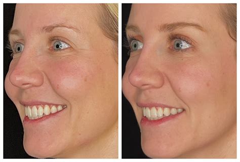 Before And After Crows Feet Neuromodulator Treatment Viva Eve