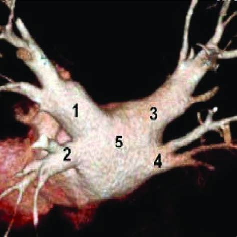flow chart  repeat ablation procedures pvi pulmonary vein isolation