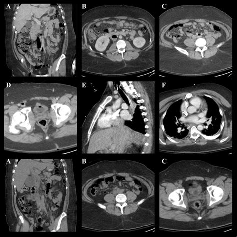 Contrasted Computed Tomography Of The Abdomen A Coronal Plane And