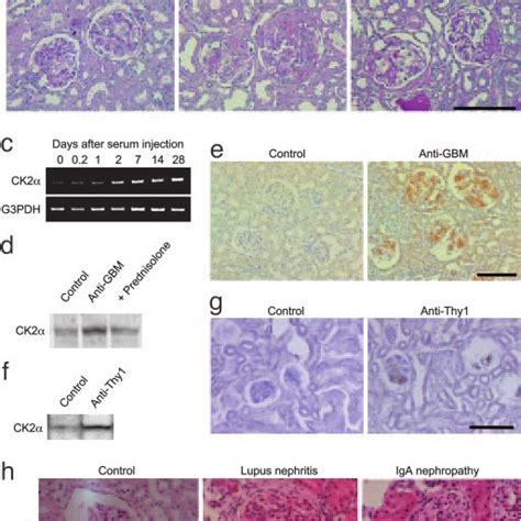 Expression Of Ck During Progression Of Gn A Urinary Protein