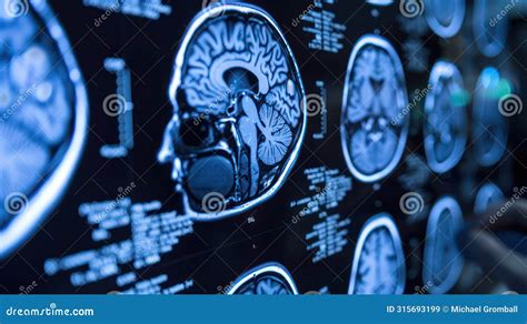 Human Brain In A Ct Scan Created With Generative Ai Scanning With X