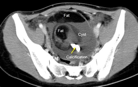 Mature ovarian teratoma – Radiology Cases