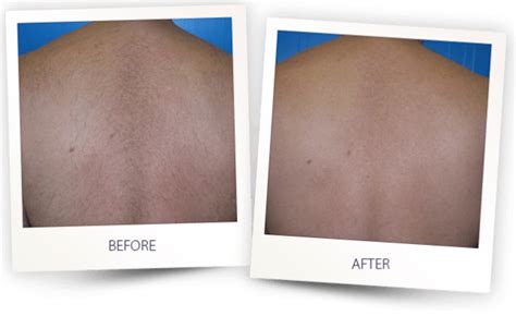 Laser Hair Removal Before And After Photos Skin Treatments