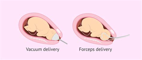 What Is Dystocia Birth